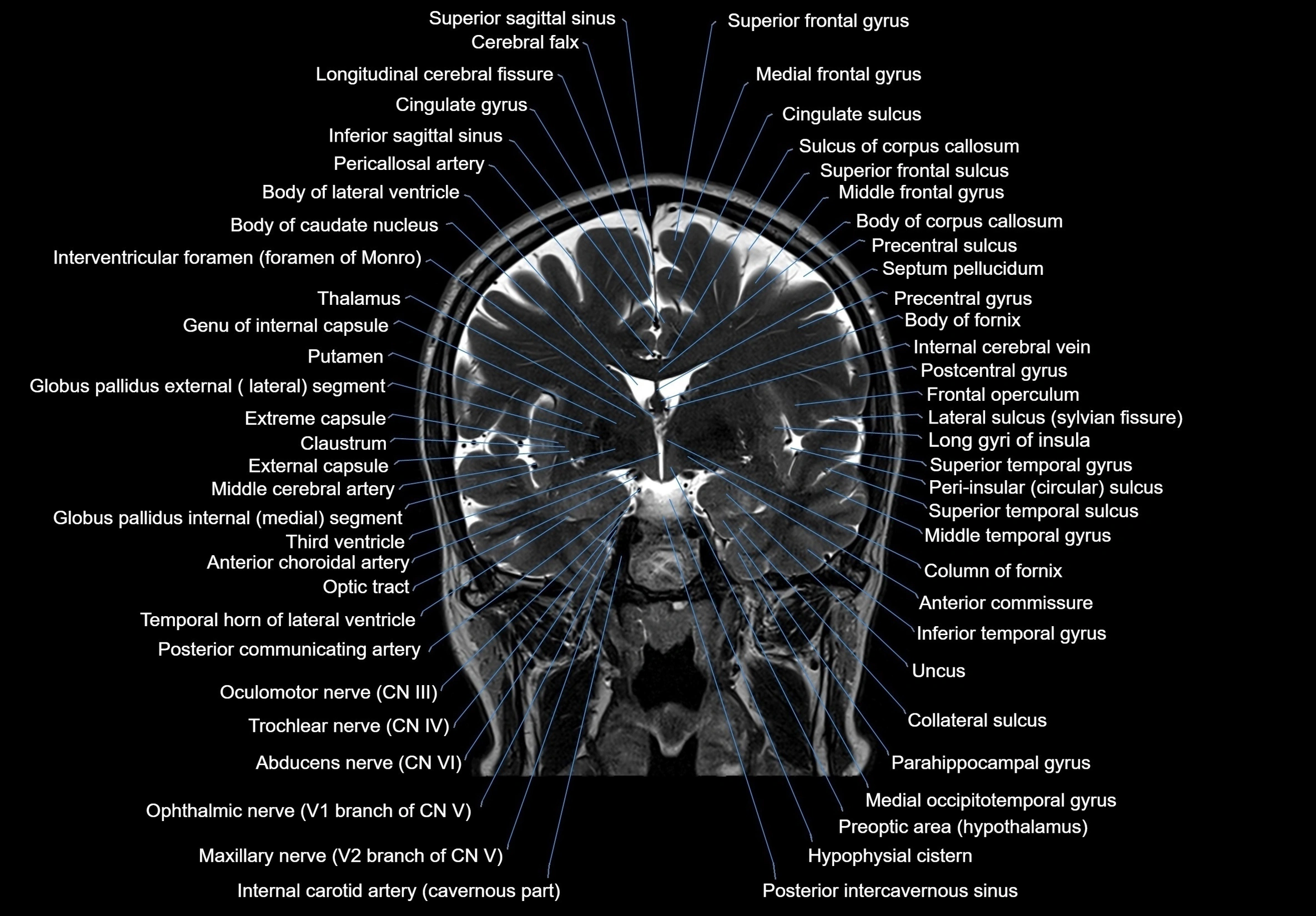MRI Brain coronal cross sectional labelled anatomy 3T image  -img-00001-00034.webp